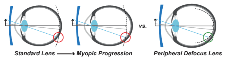 MiYOSMART glasses creating peripheral defocus for myopia control.